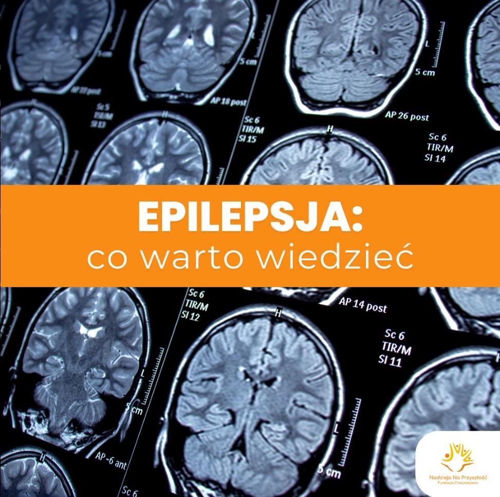 Epilepsja: co warto wiedzieć